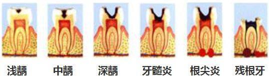 一个蛀牙而已，为什么要杀神经？这是不是过度医疗了？