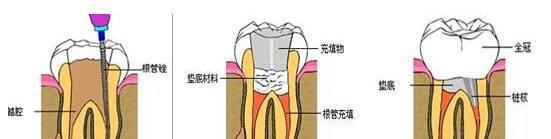 一个蛀牙而已，为什么要杀神经？这是不是过度医疗了？