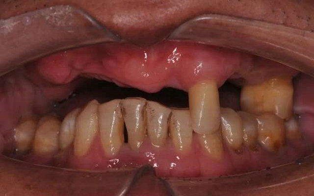 上颌牙列缺失种植固定全瓷修复一例