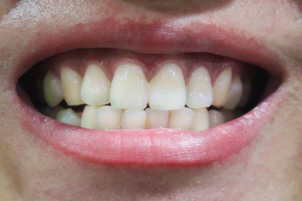 牙龈出血是小事？若是发生频率过高，也可能会暗藏疾病